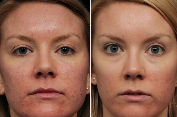 Rajeunissement au laser
