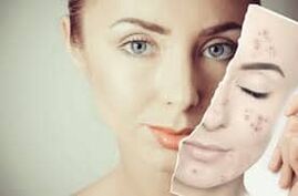 Remplacement du Botox